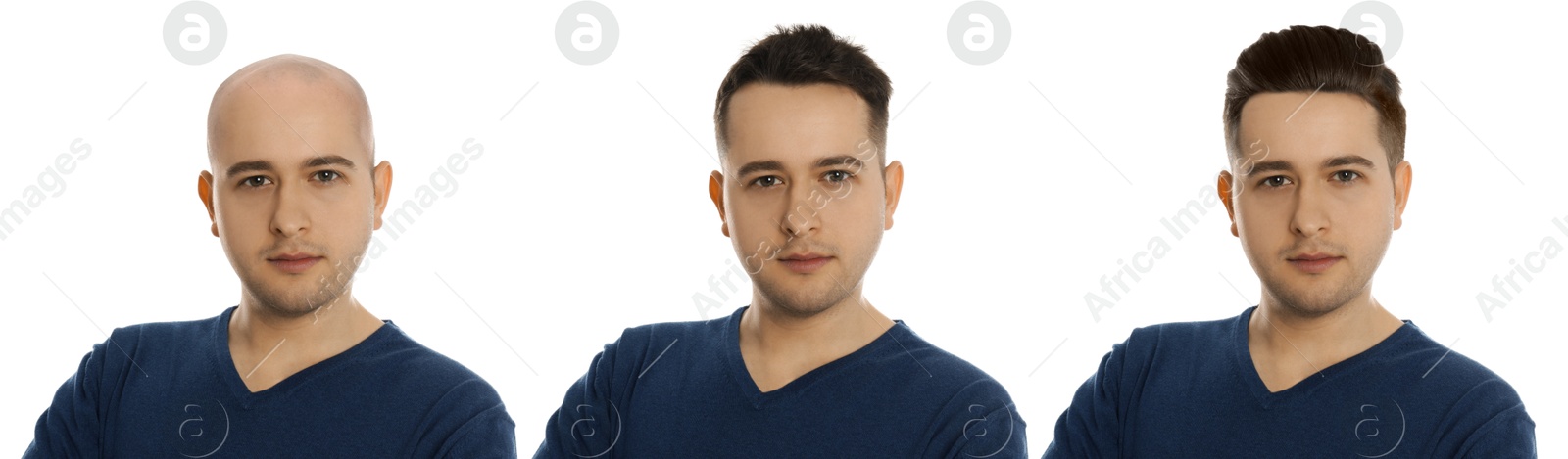 Baldness. Man before and after wearing wig or hair treatment, collage Image of Baldness. Man before and after wearing wig or hair treatment, collage