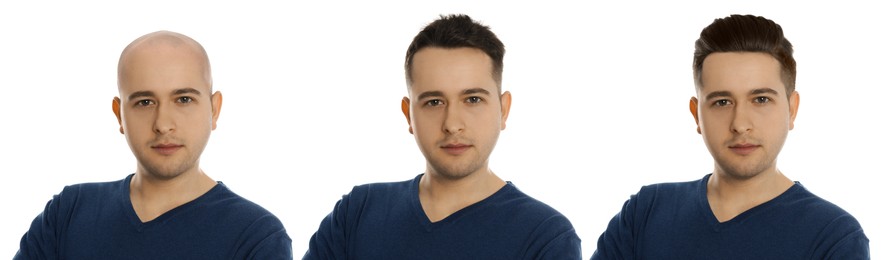 Image of Baldness. Man before and after wearing wig or hair treatment, collage