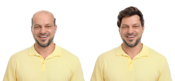 Image of Baldness. Man before and after wearing wig or hair treatment, collage