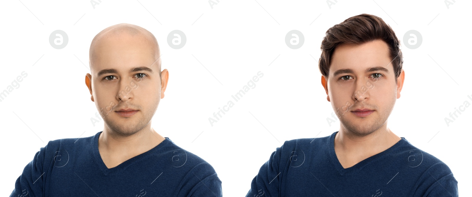 Baldness. Man before and after wearing wig or hair treatment, collage Image of Baldness. Man before and after wearing wig or hair treatment, collage
