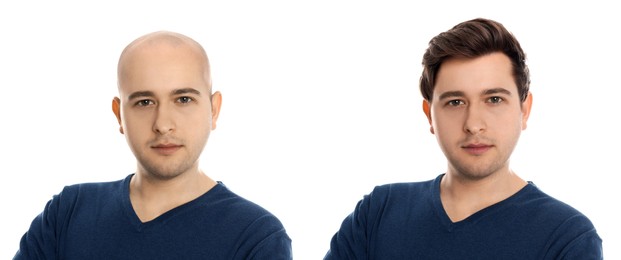 Image of Baldness. Man before and after wearing wig or hair treatment, collage