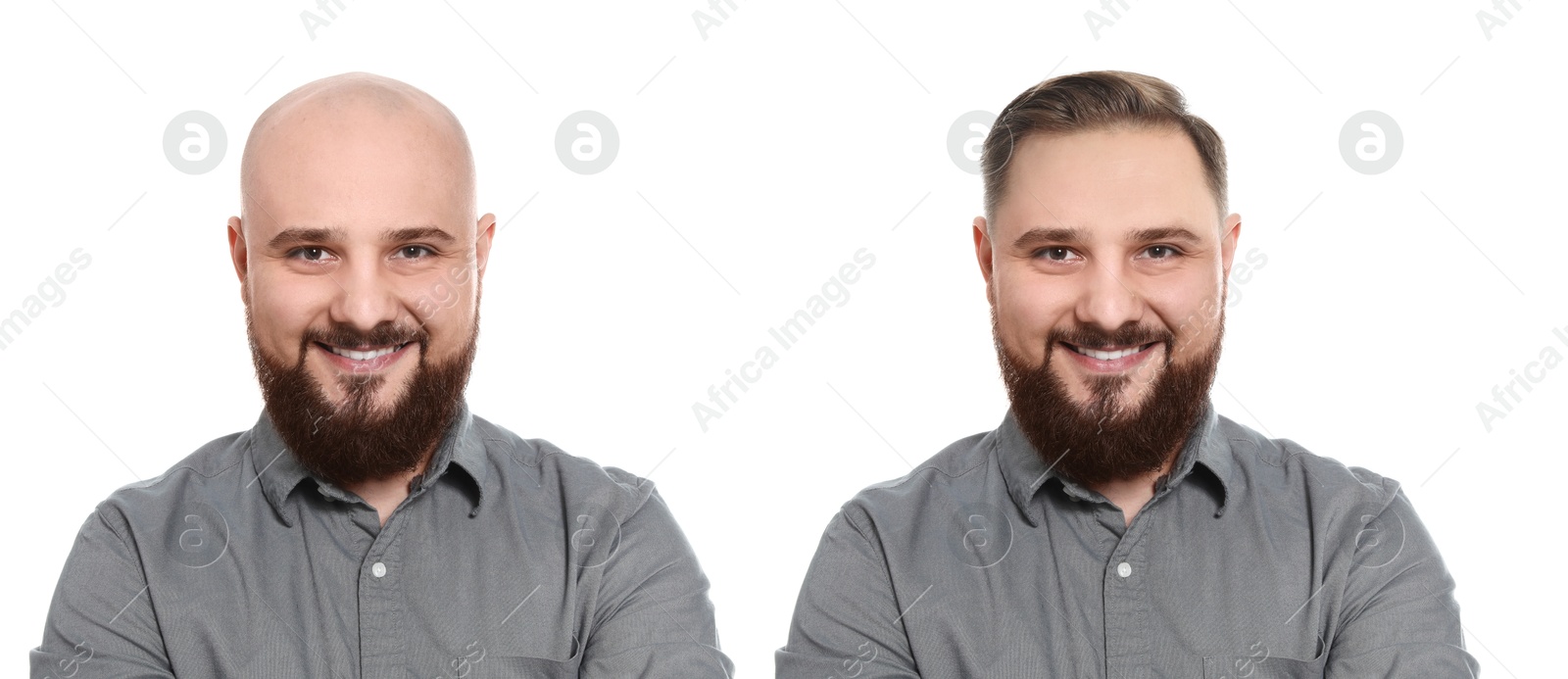 Baldness. Man before and after wearing wig or hair treatment, collage Image of Baldness. Man before and after wearing wig or hair treatment, collage