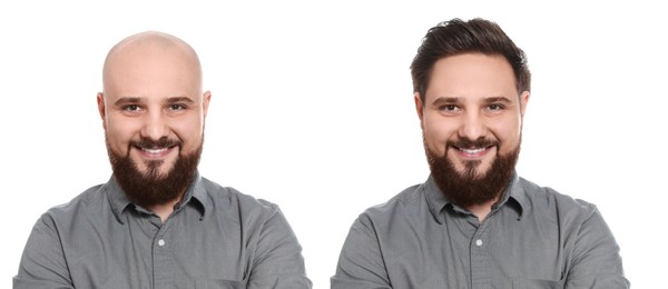 Image of Baldness. Man before and after wearing wig or hair treatment, collage