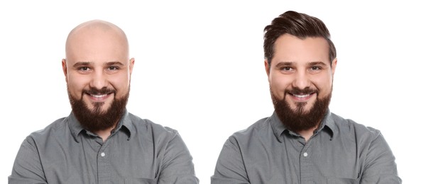 Image of Baldness. Man before and after wearing wig or hair treatment, collage