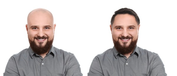 Image of Baldness. Man before and after wearing wig or hair treatment, collage