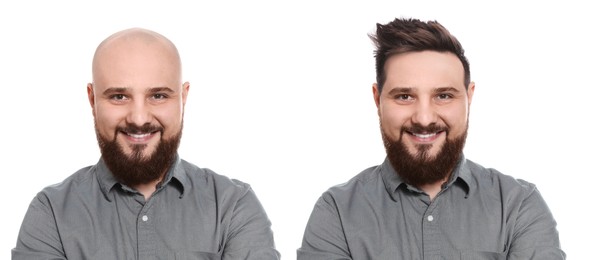 Image of Baldness. Man before and after wearing wig or hair treatment, collage