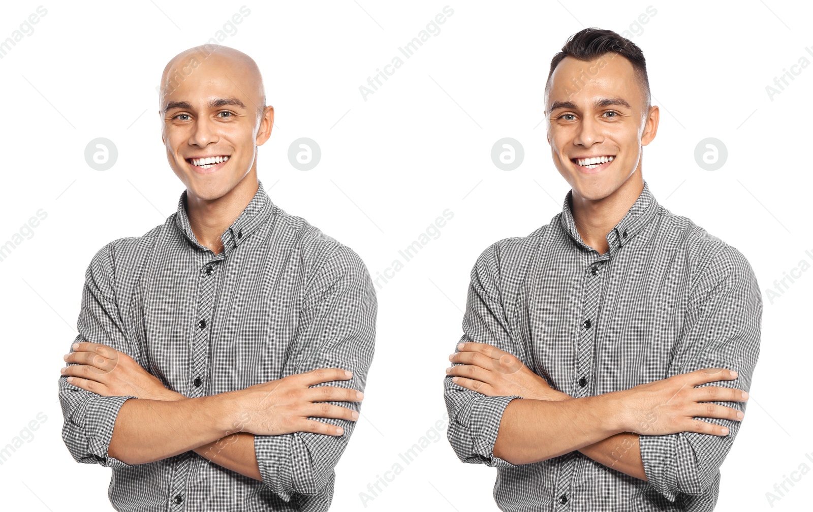 Baldness. Man before and after wearing wig or hair treatment, collage Image of Baldness. Man before and after wearing wig or hair treatment, collage