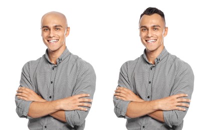 Image of Baldness. Man before and after wearing wig or hair treatment, collage