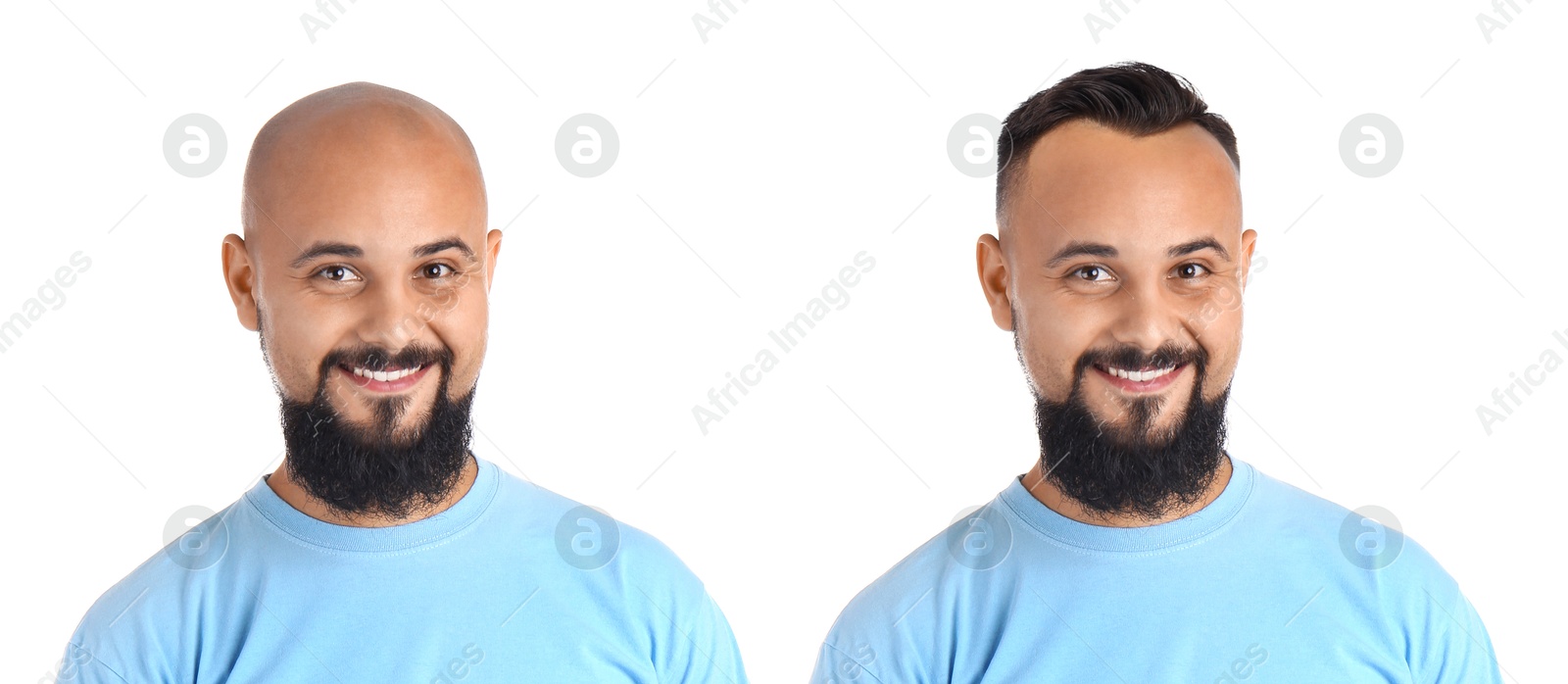 Baldness. Man before and after wearing wig or hair treatment, collage Image of Baldness. Man before and after wearing wig or hair treatment, collage