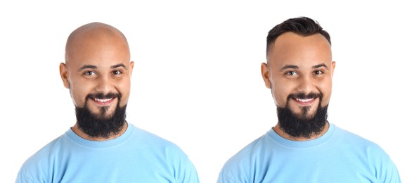 Image of Baldness. Man before and after wearing wig or hair treatment, collage