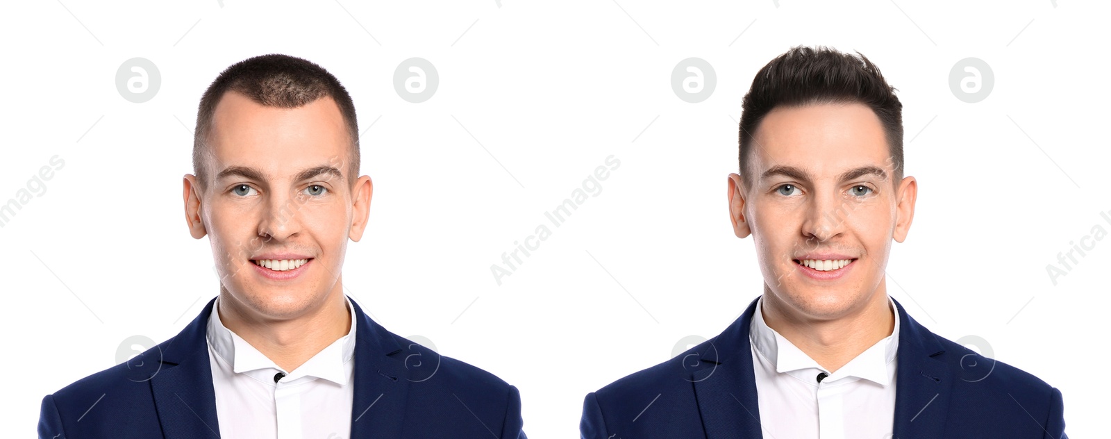 Baldness. Man before and after wearing wig or hair treatment, collage Image of Baldness. Man before and after wearing wig or hair treatment, collage