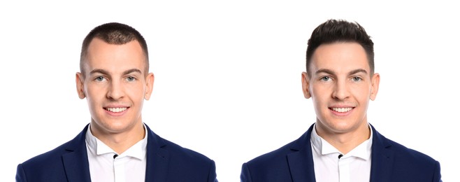 Image of Baldness. Man before and after wearing wig or hair treatment, collage