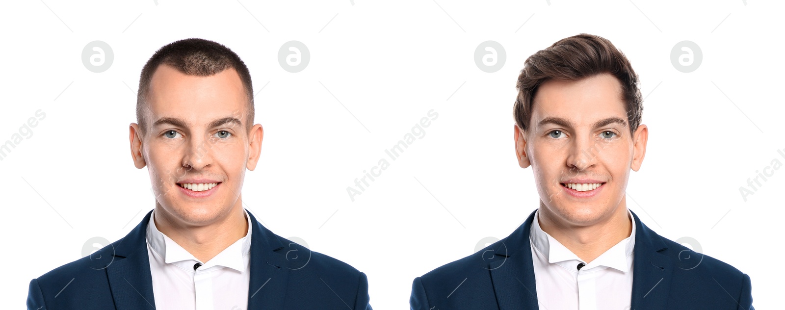 Image of Baldness. Man before and after wearing wig or hair treatment, collage