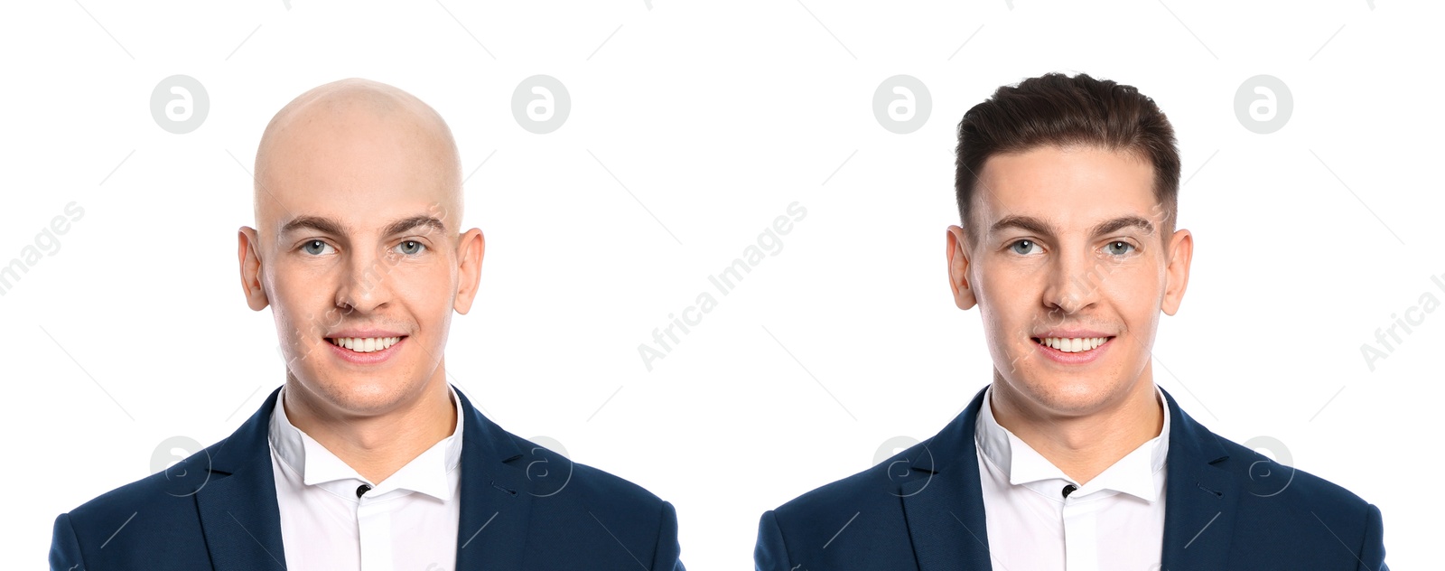 Image of Baldness. Man before and after wearing wig or hair treatment, collage