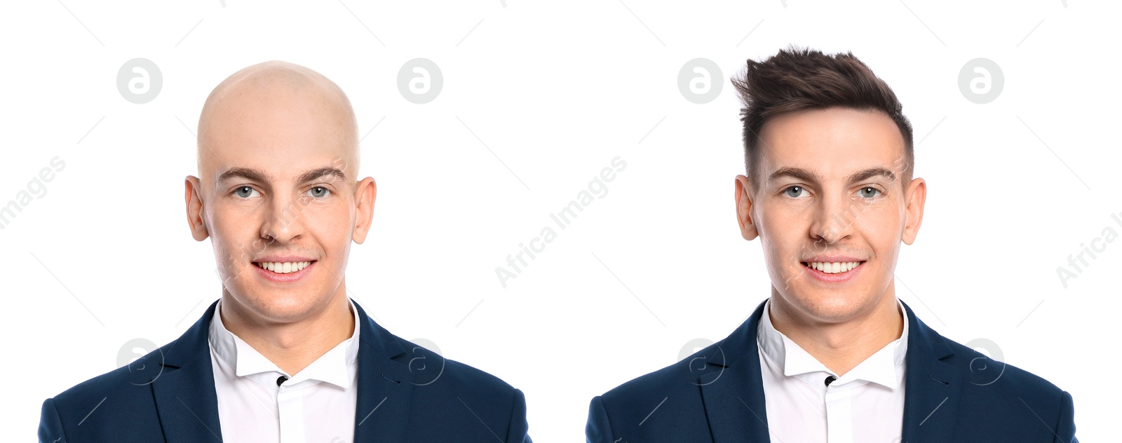 Baldness. Man before and after wearing wig or hair treatment, collage Image of Baldness. Man before and after wearing wig or hair treatment, collage