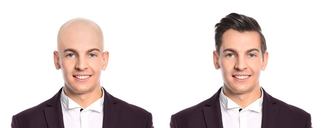 Image of Baldness. Man before and after wearing wig or hair treatment, collage