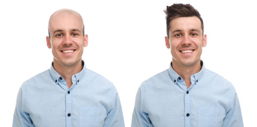 Image of Baldness. Man before and after wearing wig or hair treatment, collage