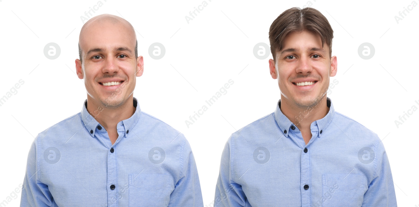 Baldness. Man before and after wearing wig or hair treatment, collage Image of Baldness. Man before and after wearing wig or hair treatment, collage