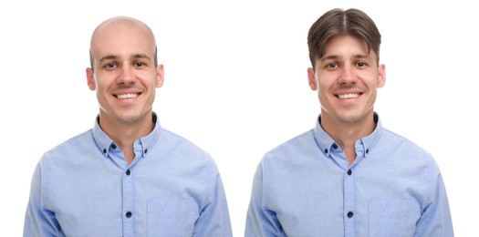 Image of Baldness. Man before and after wearing wig or hair treatment, collage