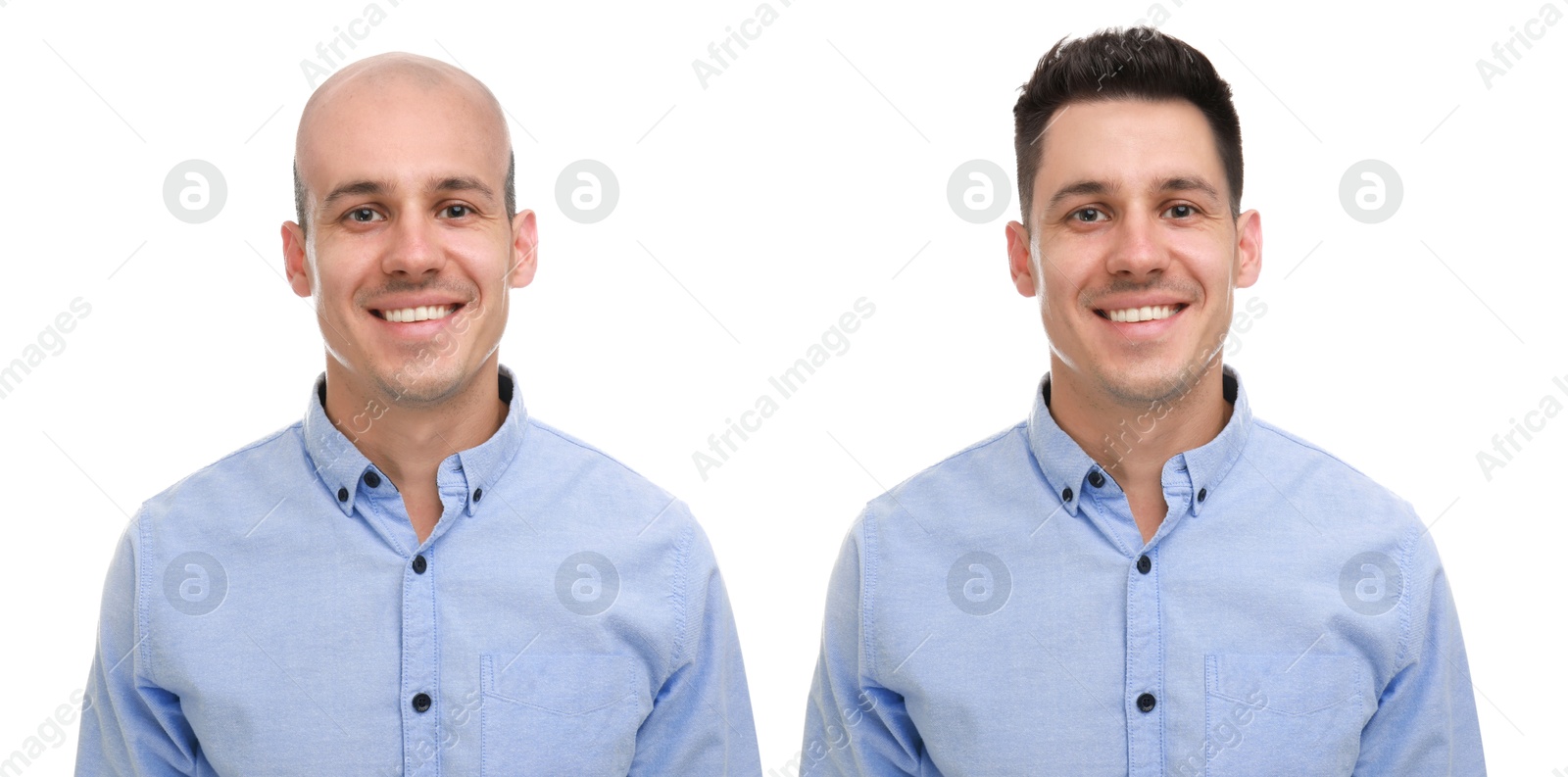 Baldness. Man before and after wearing wig or hair treatment, collage Image of Baldness. Man before and after wearing wig or hair treatment, collage