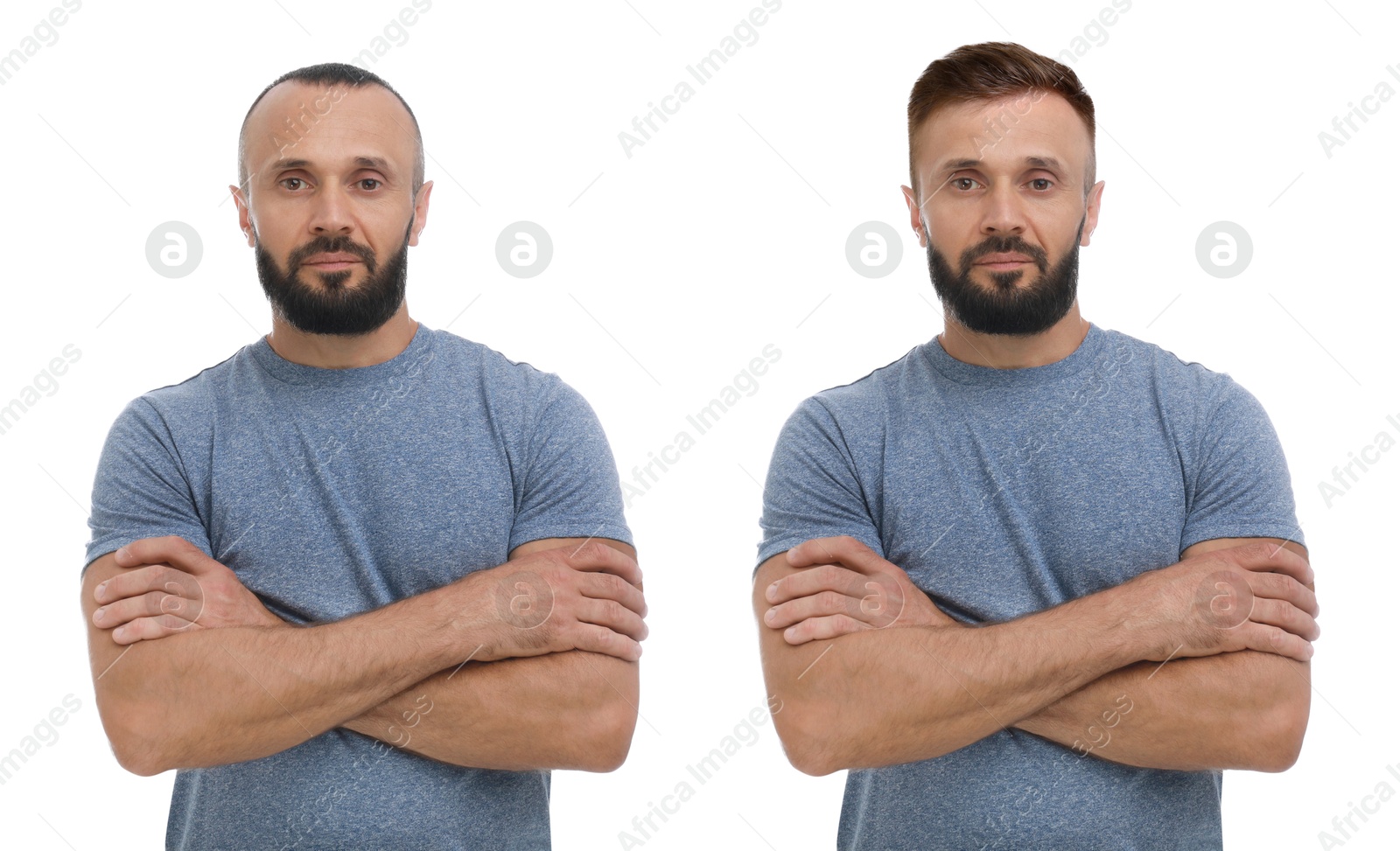 Baldness. Man before and after wearing wig or hair treatment, collage Image of Baldness. Man before and after wearing wig or hair treatment, collage