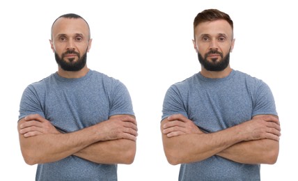 Image of Baldness. Man before and after wearing wig or hair treatment, collage