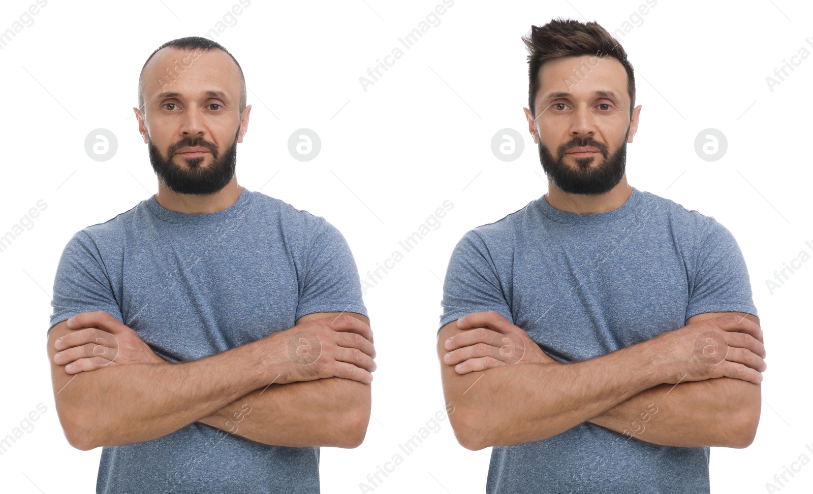 Baldness. Man before and after wearing wig or hair treatment, collage Image of Baldness. Man before and after wearing wig or hair treatment, collage