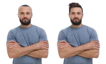 Image of Baldness. Man before and after wearing wig or hair treatment, collage