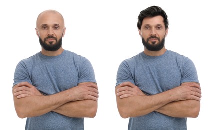 Image of Baldness. Man before and after wearing wig or hair treatment, collage