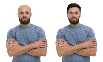 Image of Baldness. Man before and after wearing wig or hair treatment, collage