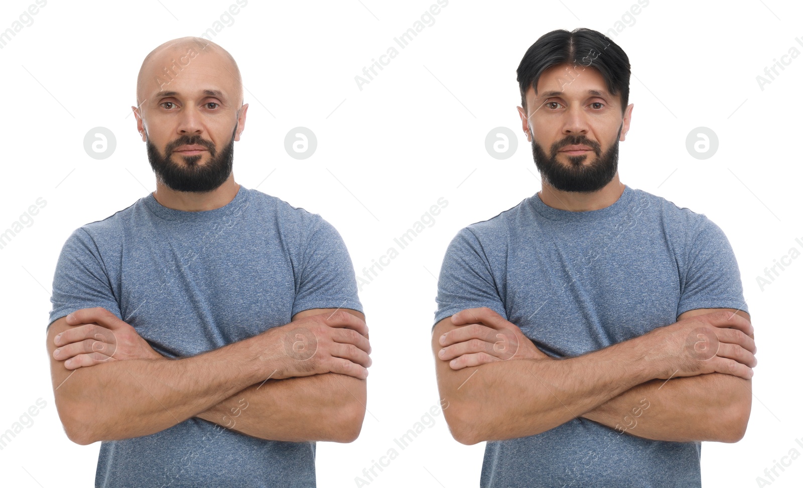 Baldness. Man before and after wearing wig or hair treatment, collage Image of Baldness. Man before and after wearing wig or hair treatment, collage