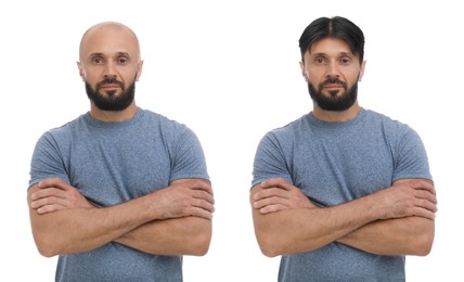 Image of Baldness. Man before and after wearing wig or hair treatment, collage
