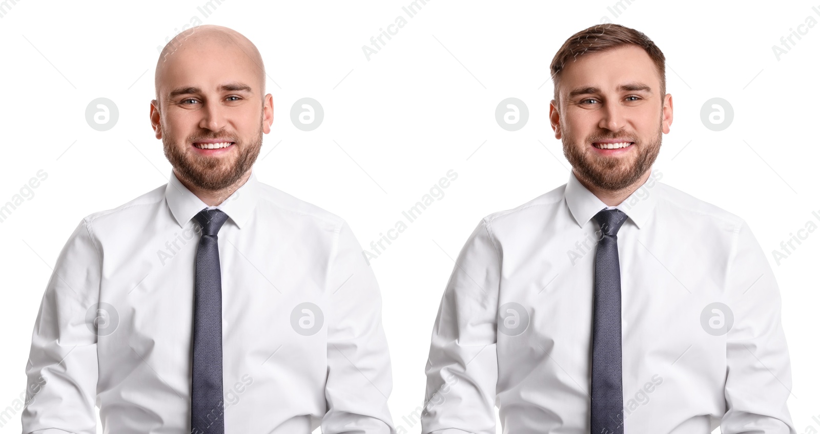 Baldness. Man before and after wearing wig or hair treatment, collage Image of Baldness. Man before and after wearing wig or hair treatment, collage