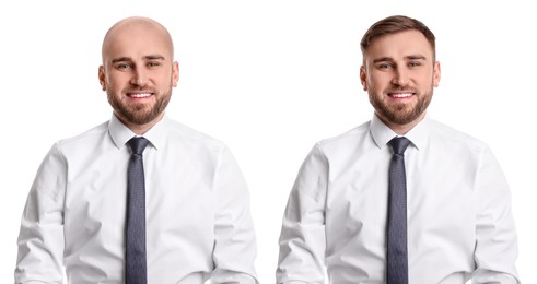 Image of Baldness. Man before and after wearing wig or hair treatment, collage
