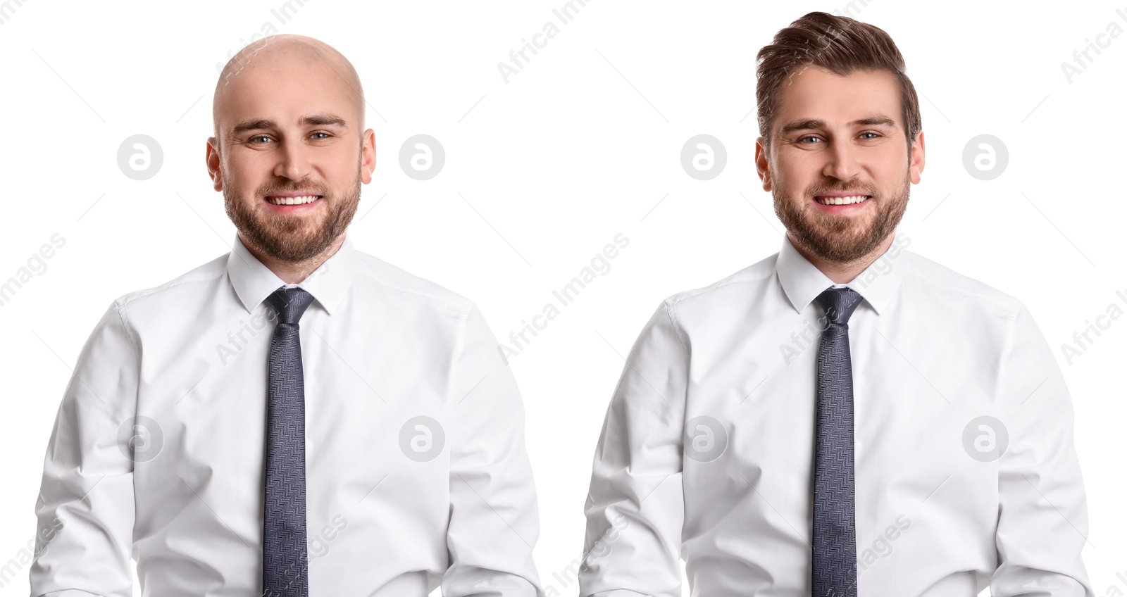 Baldness. Man before and after wearing wig or hair treatment, collage Image of Baldness. Man before and after wearing wig or hair treatment, collage