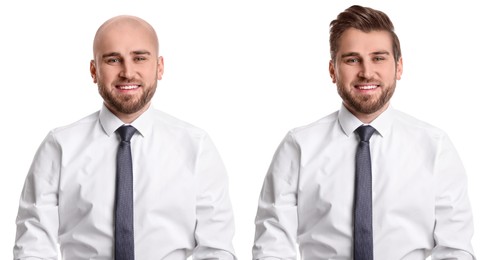 Image of Baldness. Man before and after wearing wig or hair treatment, collage