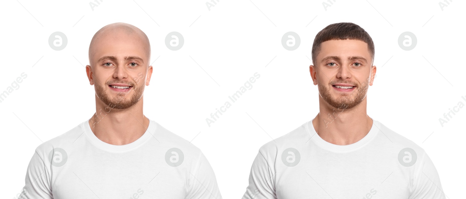 Baldness. Man before and after wearing wig or hair treatment, collage Image of Baldness. Man before and after wearing wig or hair treatment, collage