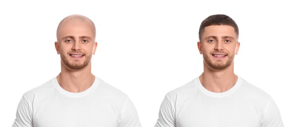 Image of Baldness. Man before and after wearing wig or hair treatment, collage