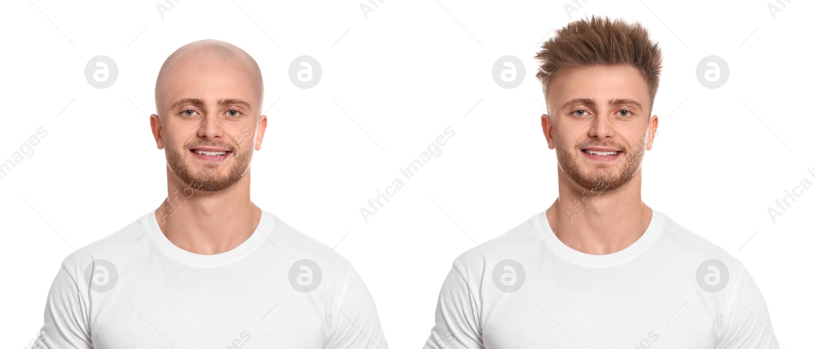Baldness. Man before and after wearing wig or hair treatment, collage Image of Baldness. Man before and after wearing wig or hair treatment, collage