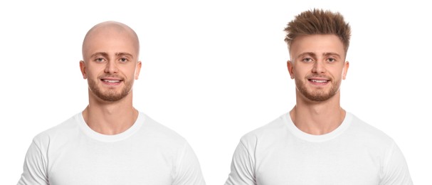 Image of Baldness. Man before and after wearing wig or hair treatment, collage