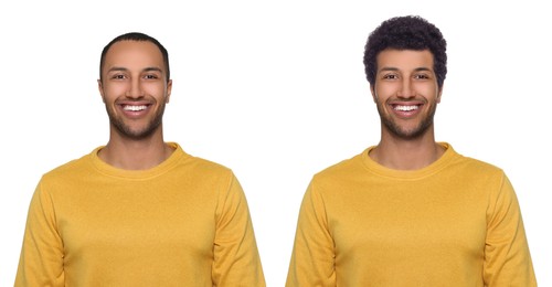 Image of Baldness. Man before and after wearing wig or hair treatment, collage