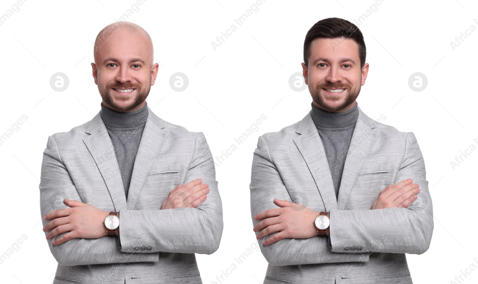 Baldness. Man before and after wearing wig or hair treatment, collage Image of Baldness. Man before and after wearing wig or hair treatment, collage