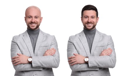Image of Baldness. Man before and after wearing wig or hair treatment, collage