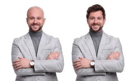 Image of Baldness. Man before and after wearing wig or hair treatment, collage