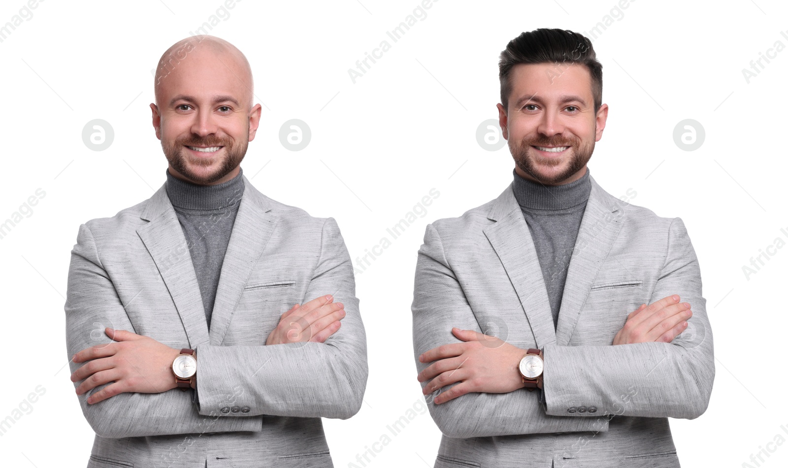 Baldness. Man before and after wearing wig or hair treatment, collage Image of Baldness. Man before and after wearing wig or hair treatment, collage