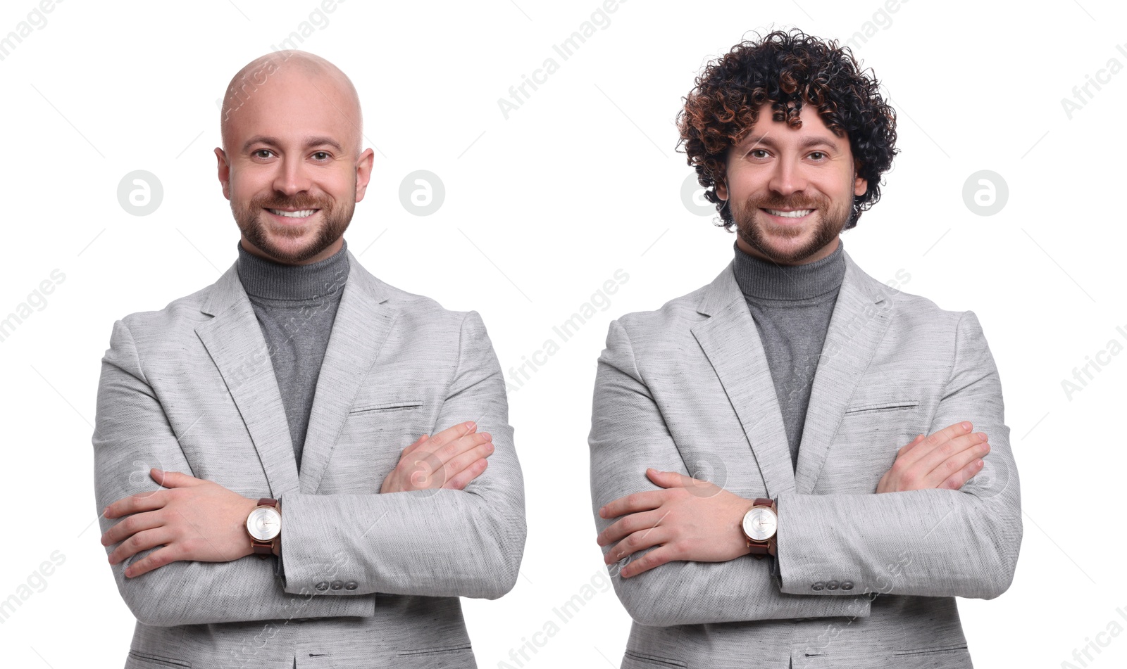Baldness. Man before and after wearing wig or hair treatment, collage Image of Baldness. Man before and after wearing wig or hair treatment, collage