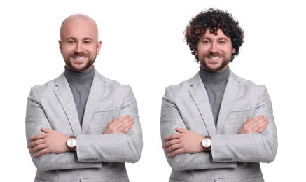 Image of Baldness. Man before and after wearing wig or hair treatment, collage
