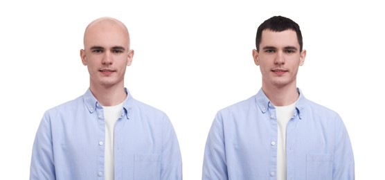 Image of Baldness. Man before and after wearing wig or hair treatment, collage