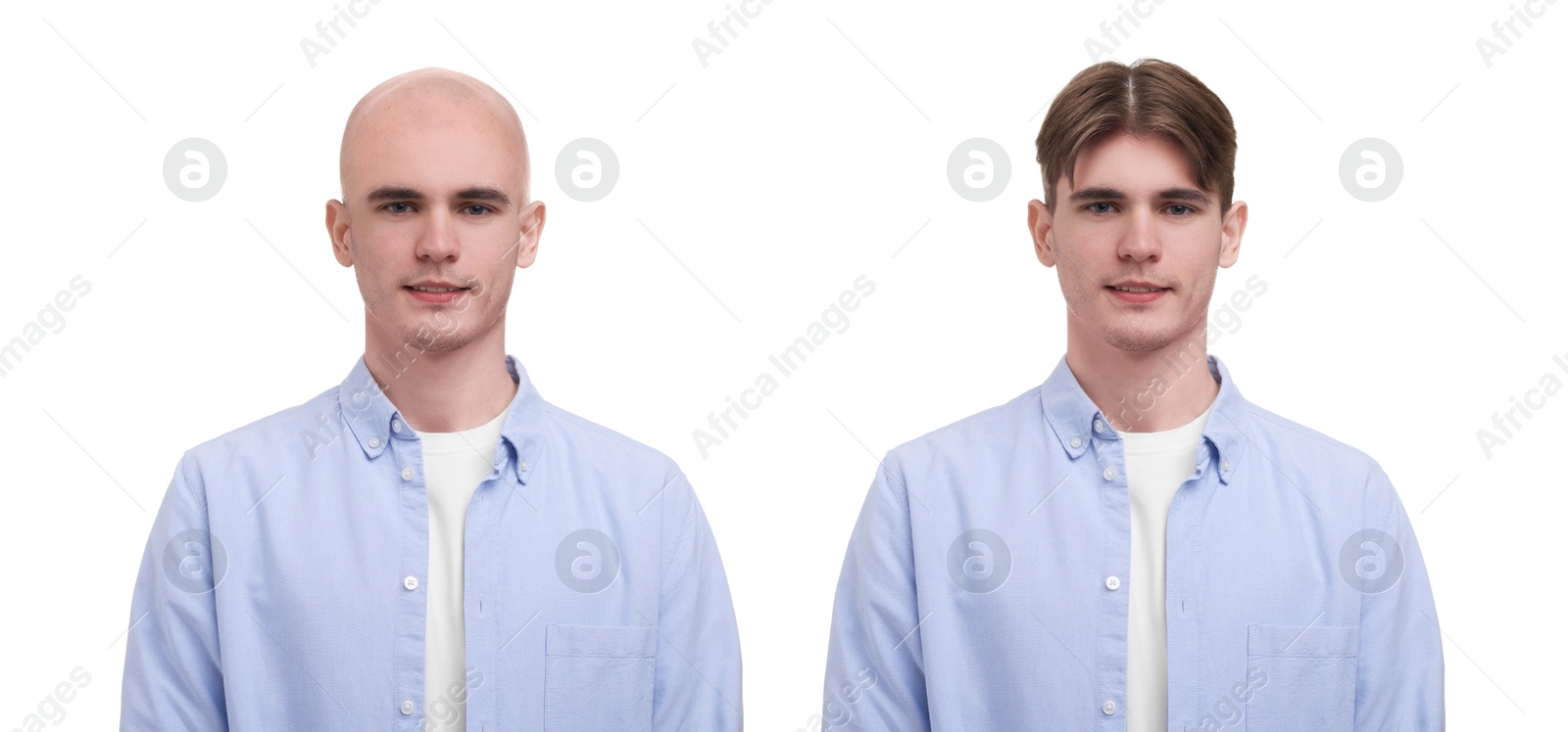 Baldness. Man before and after wearing wig or hair treatment, collage Image of Baldness. Man before and after wearing wig or hair treatment, collage