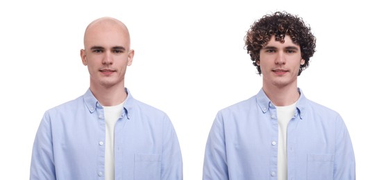 Image of Baldness. Man before and after wearing wig or hair treatment, collage